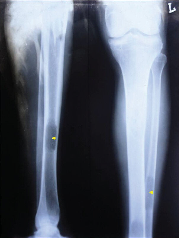 72-year-old male with a swelling in the mandible and the left lower leg, diagnosed with multiple myeloma. Conventional radiograph show lytic lesions in the left fibula and the right tibia (arrowheads).
